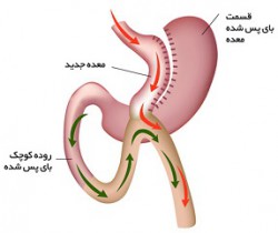 گاسترینگ بای پس